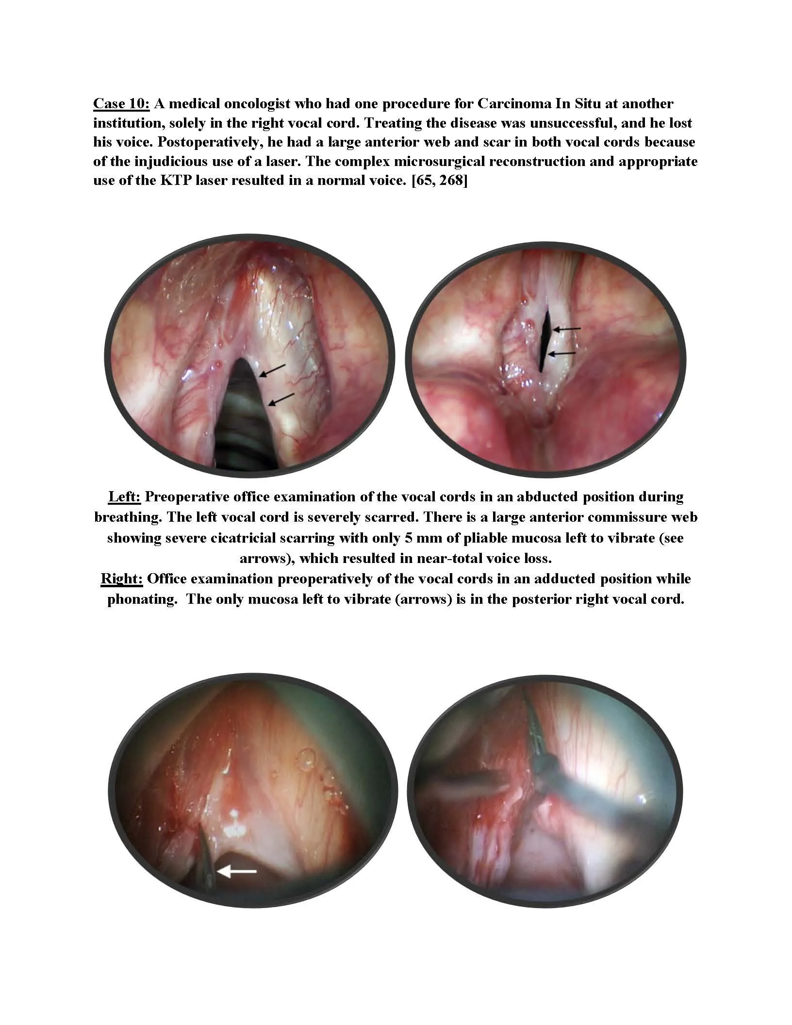Carcinoma in Situ of the Vocal Cords