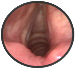 Benign Nerve Sheath Tumor of the Larynx