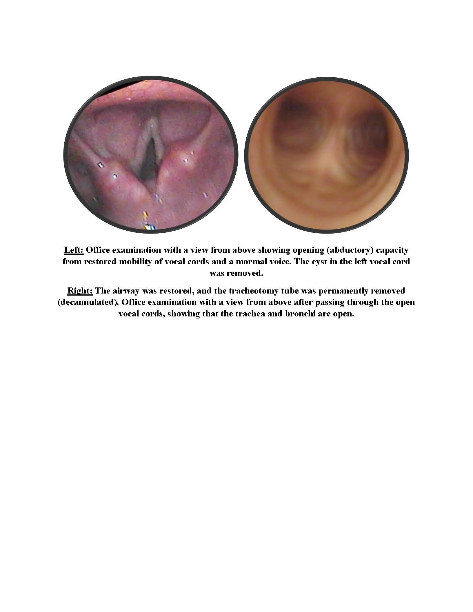 Restored Airway in Patient with Glottic Stenosis