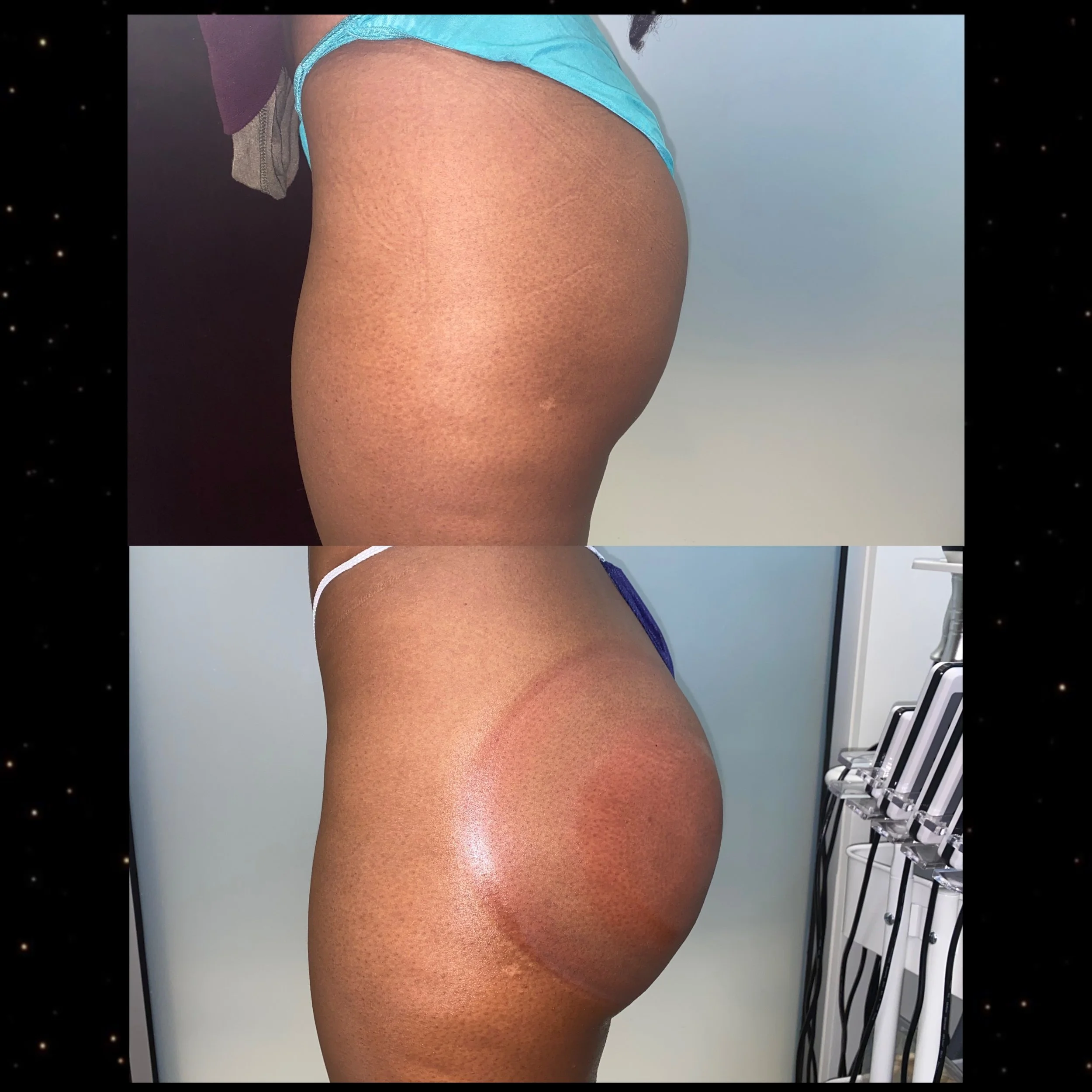 Butt Enhancement
