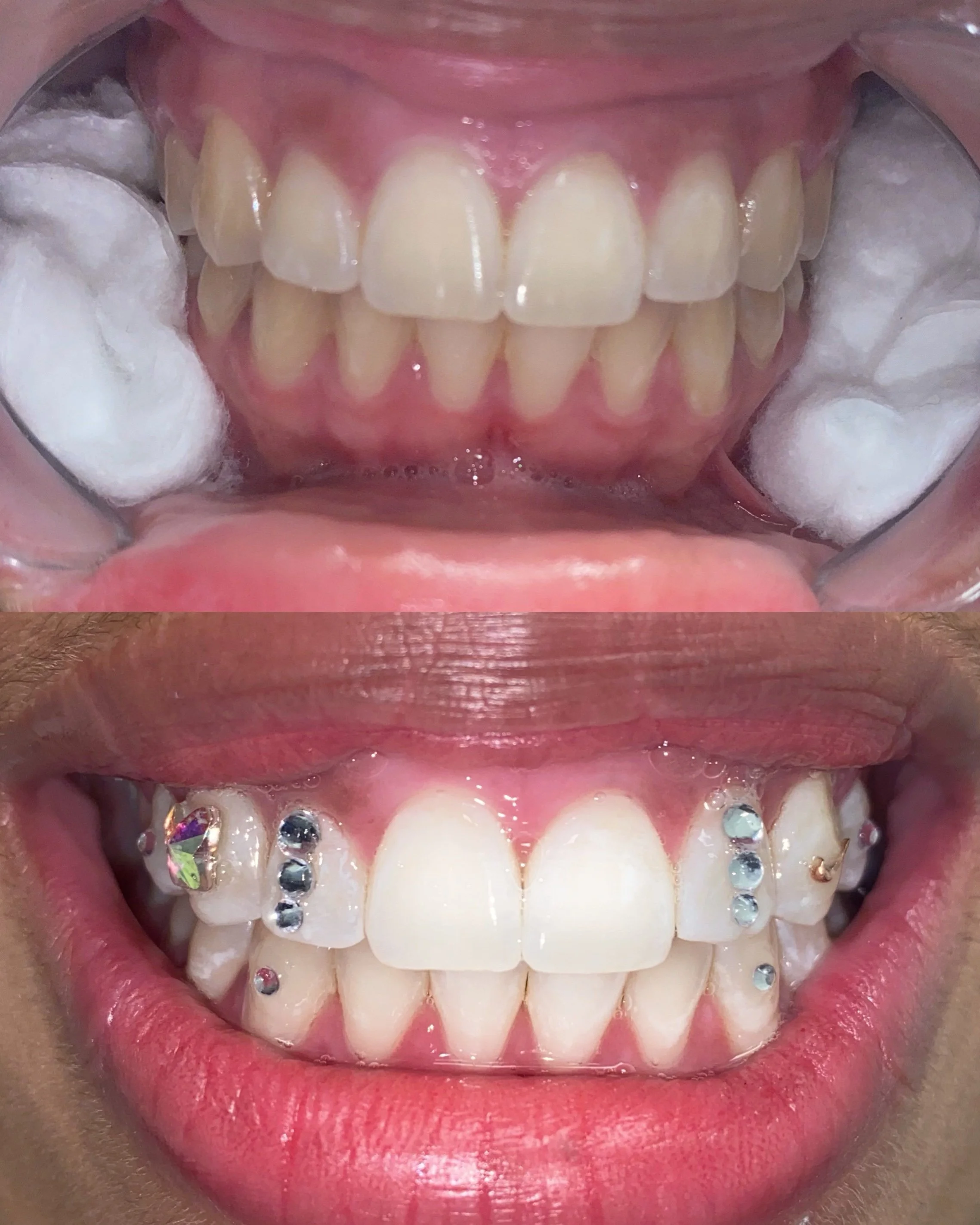 Teeth Whitening (Add On Tooth Gems)