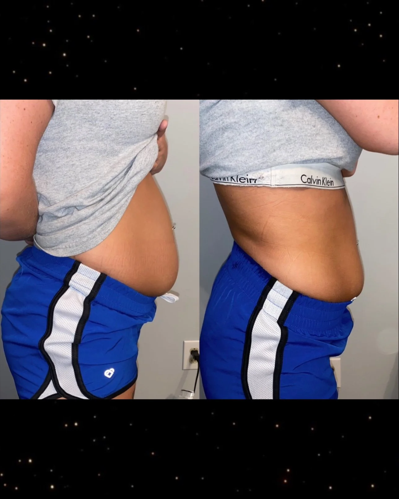 Lipo Cavitation