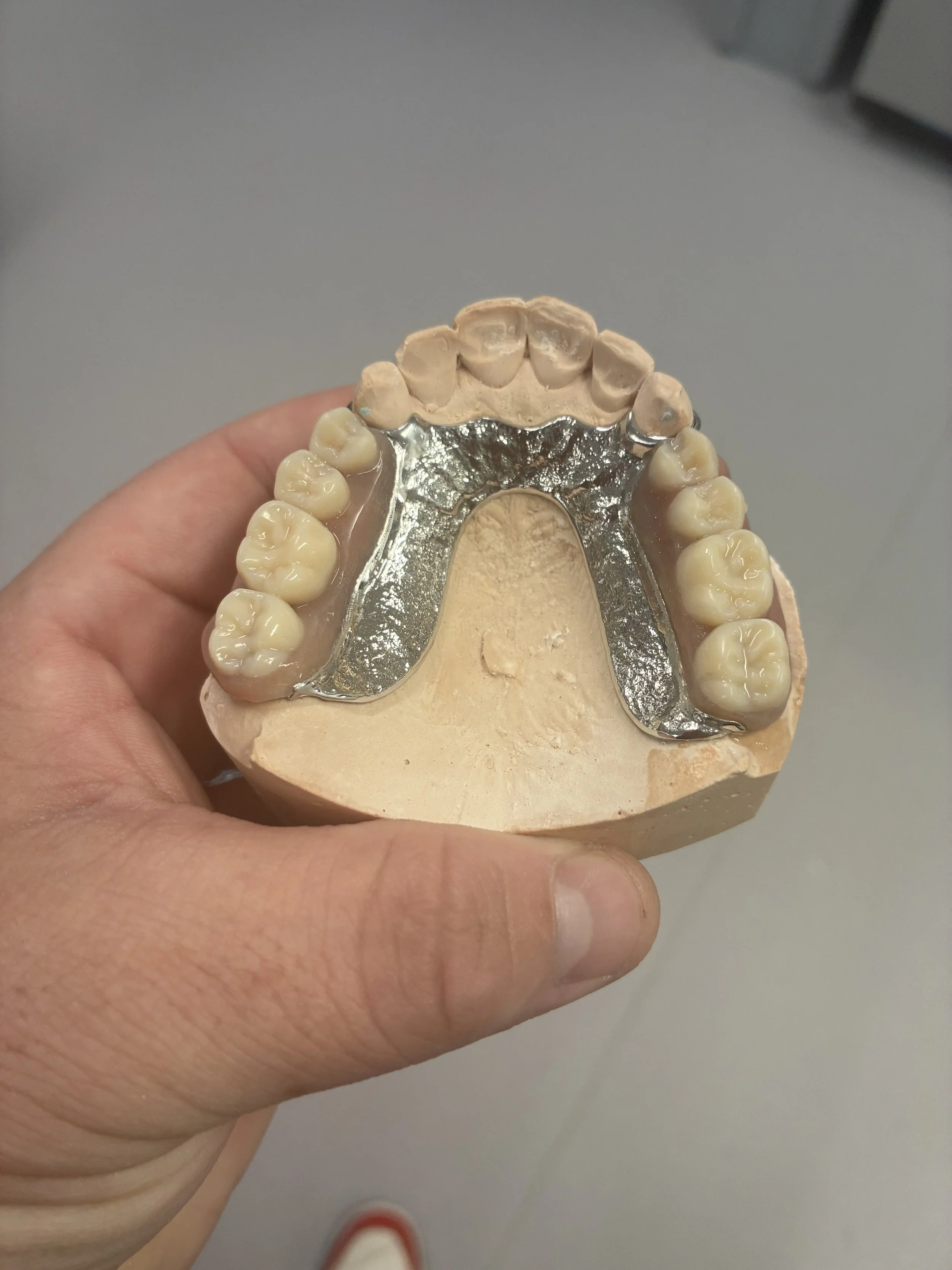 A human hand holding a dental cast of the upper teeth, which includes a metal partial denture on the right side.