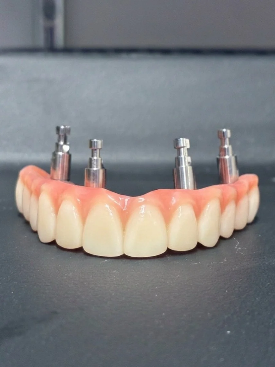 Dental implant denture with artificial teeth and metal abutments on a black surface.