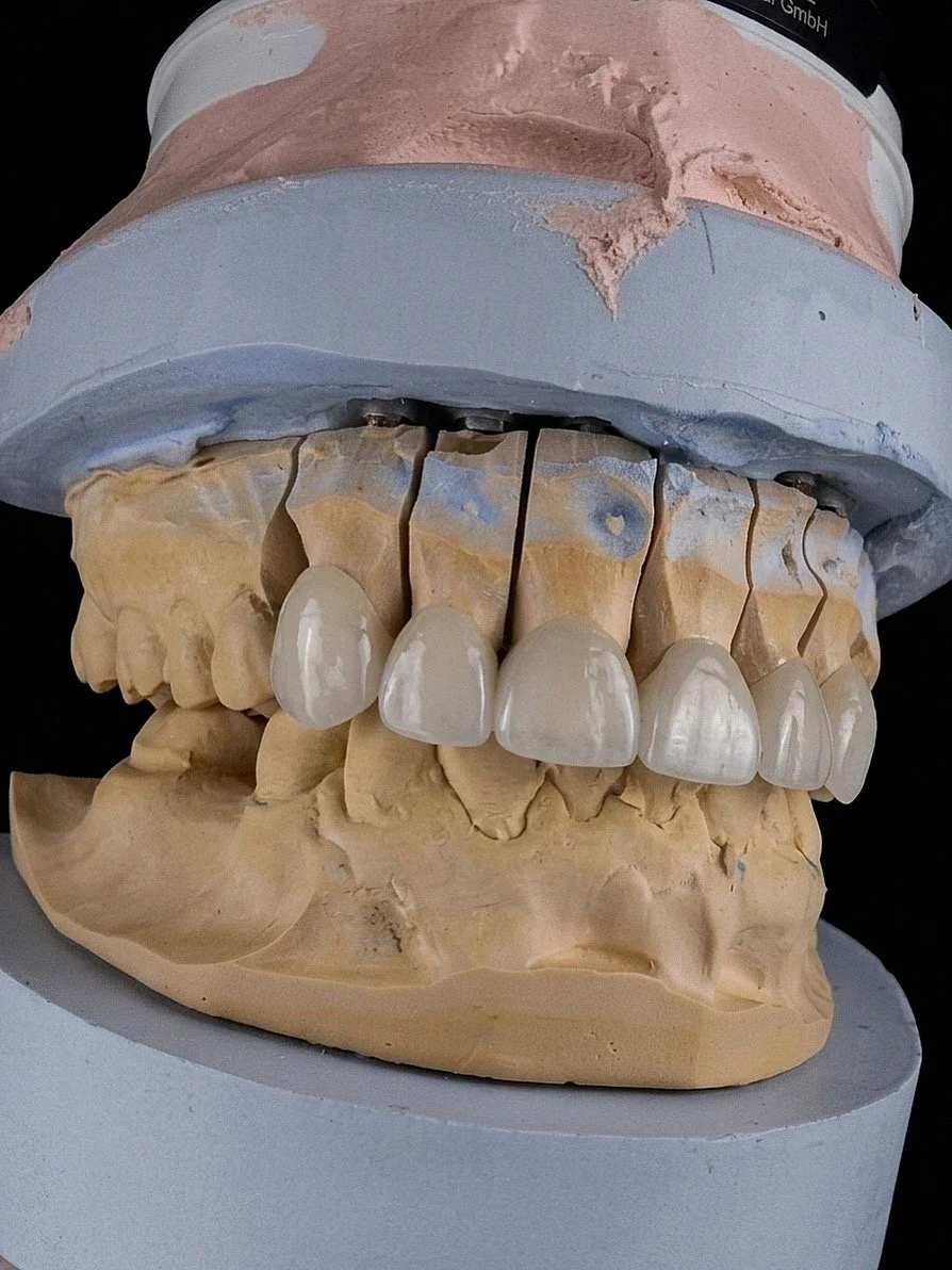 A dental model showing the upper and lower teeth, with some of the teeth appearing to be dental crowns or veneers.