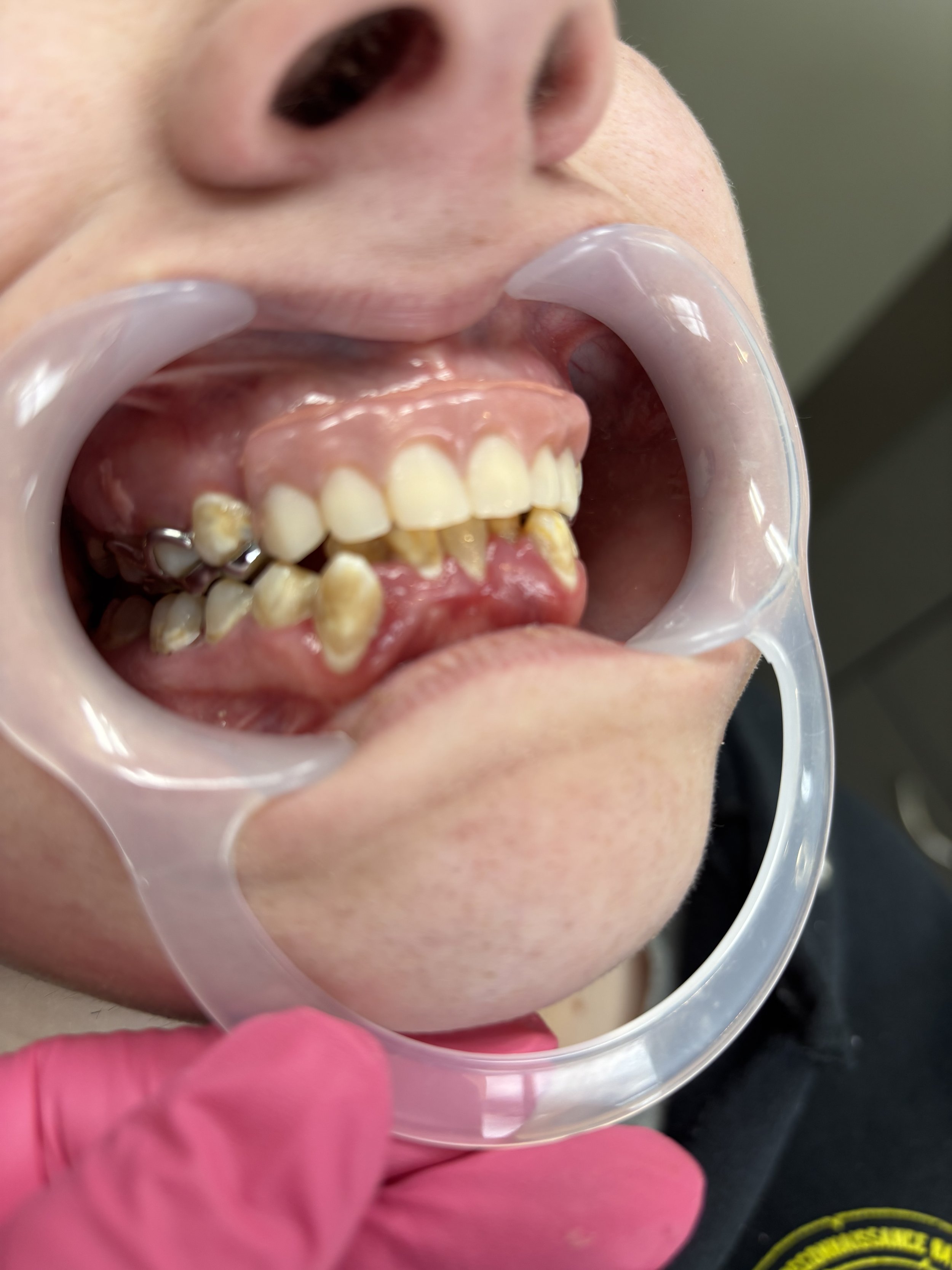 A close-up of a person's open mouth with a dental mirror reflecting the teeth and gums. The person appears to be at a dental appointment, with a gloved hand visible holding the mirror.