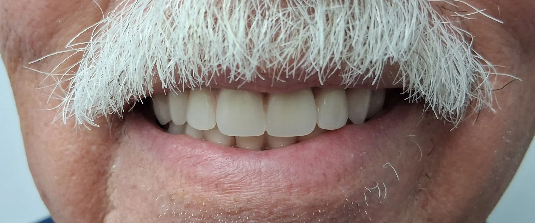 A close-up of a person's mouth showing white teeth, a mustache, and some facial hair.