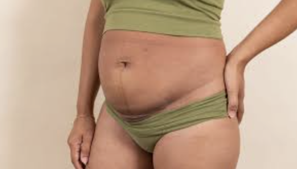 Cesarean-section Scar Management