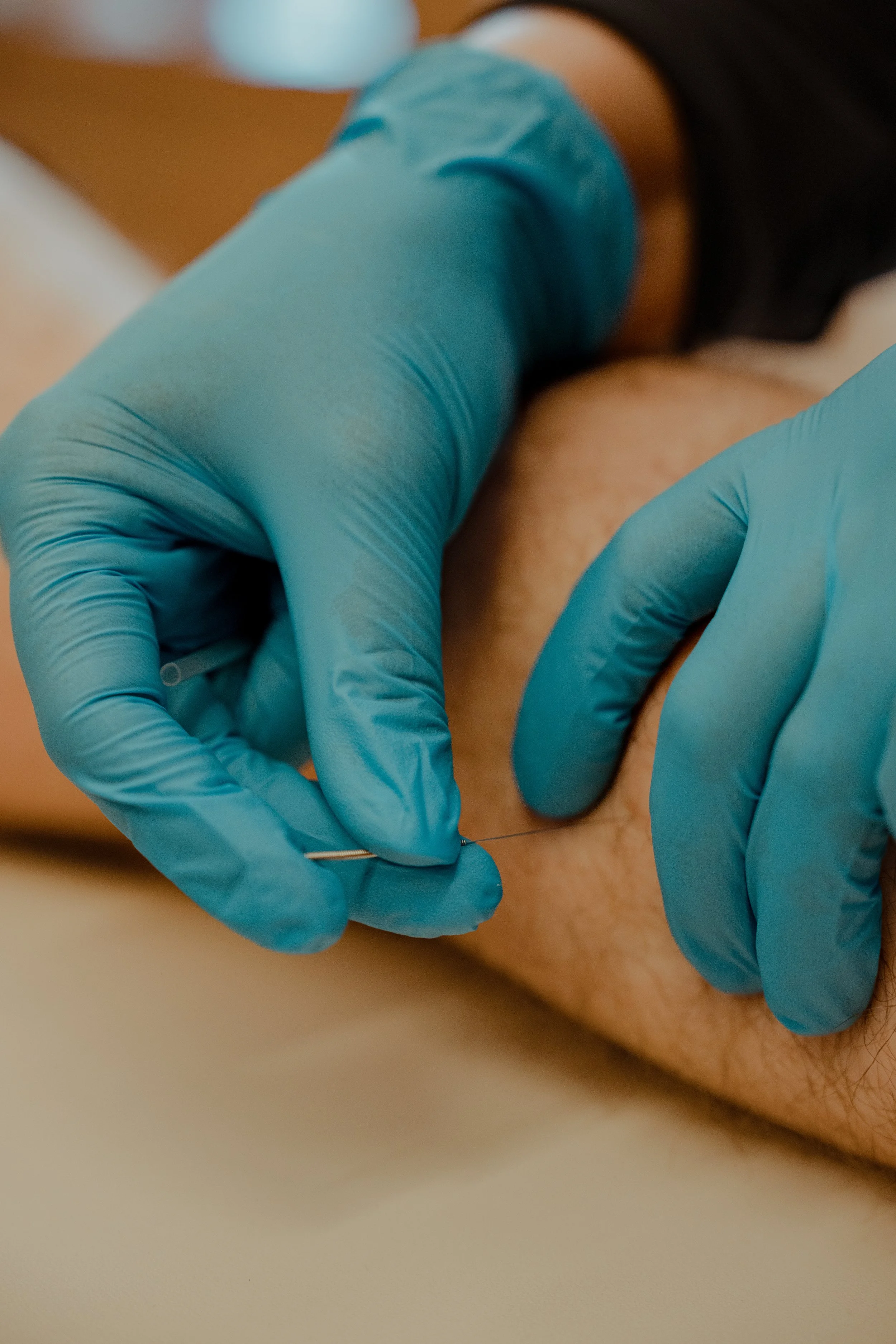 Dry Needling: It’s Not as Scary as it Sounds!