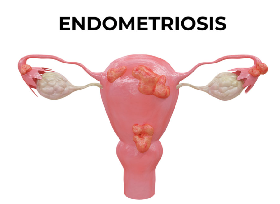 Endometriosis Explained