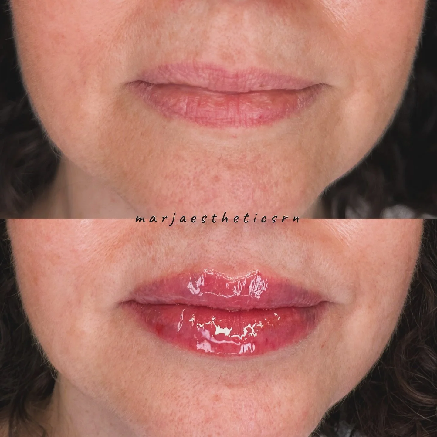There was asymmetry in the top lip, so I enhanced the right side to create better balance and added structure to her Cupid&rsquo;s bow. She now has natural-looking volume and hydration that complements her features and fits her face beautifully.

Sub