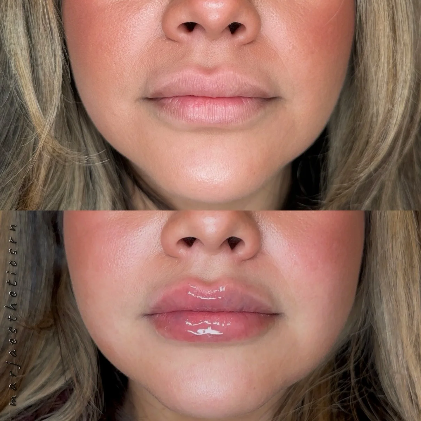 We enhanced this beauty&rsquo;s cupid&rsquo;s bow while improving symmetry between the upper and lower lip, restoring softness and subtle volume all while maintaining a natural result💋💉 

DM or hit the link in bio to book ✨ 
@touchdmedicalspa 

#me