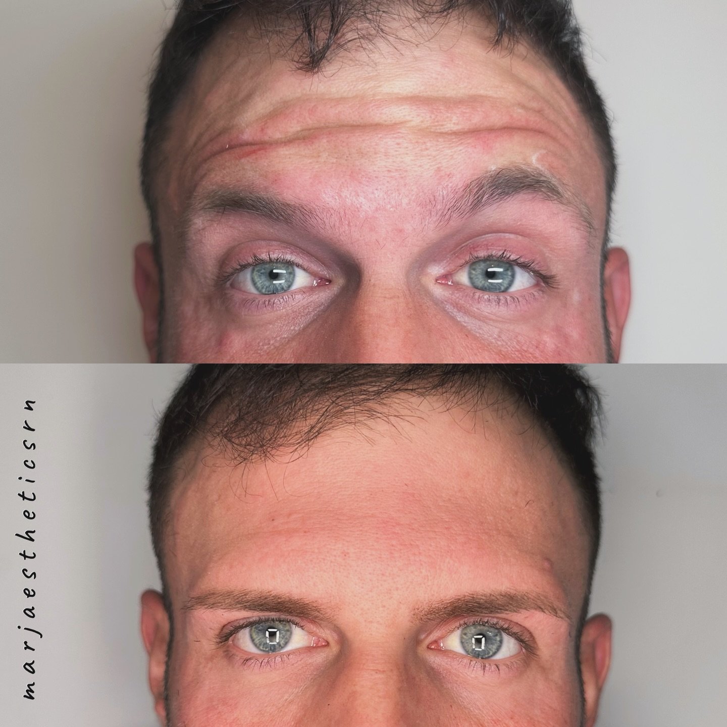 Much smoother 😘

#botox #medspa #ａｅｓｔｈｅｔｉｃ