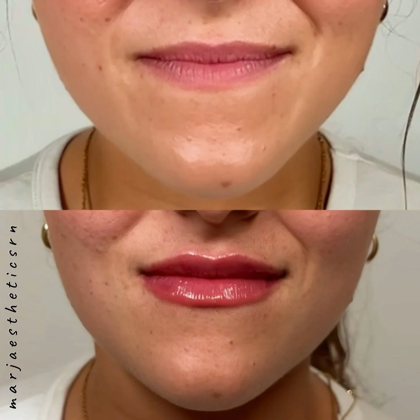 Natural, balanced, and subtle! 💋 

Come visit for your first time!
@touchdmedicalspa 

DM me or click the link in bio to book 😘

#lips #filler #nurseinjector
