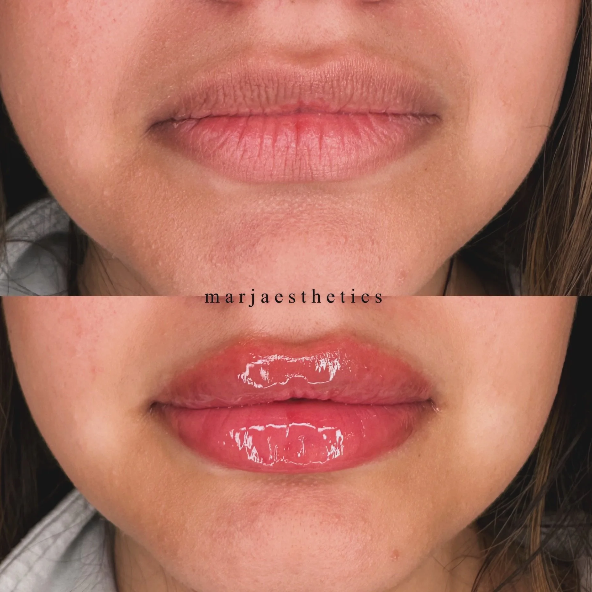 Can you even tell?! 👀 

Natural lip filler that adds volume without losing your look 💋 

DM or hit the link in bio to book!

#lip #lipfiller #nurseinjector #marjaesthetics #aesthetics