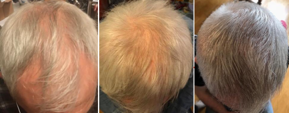 Three images of the top of a person's head showing different stages or styles of hair growth, all with gray or blond hair.