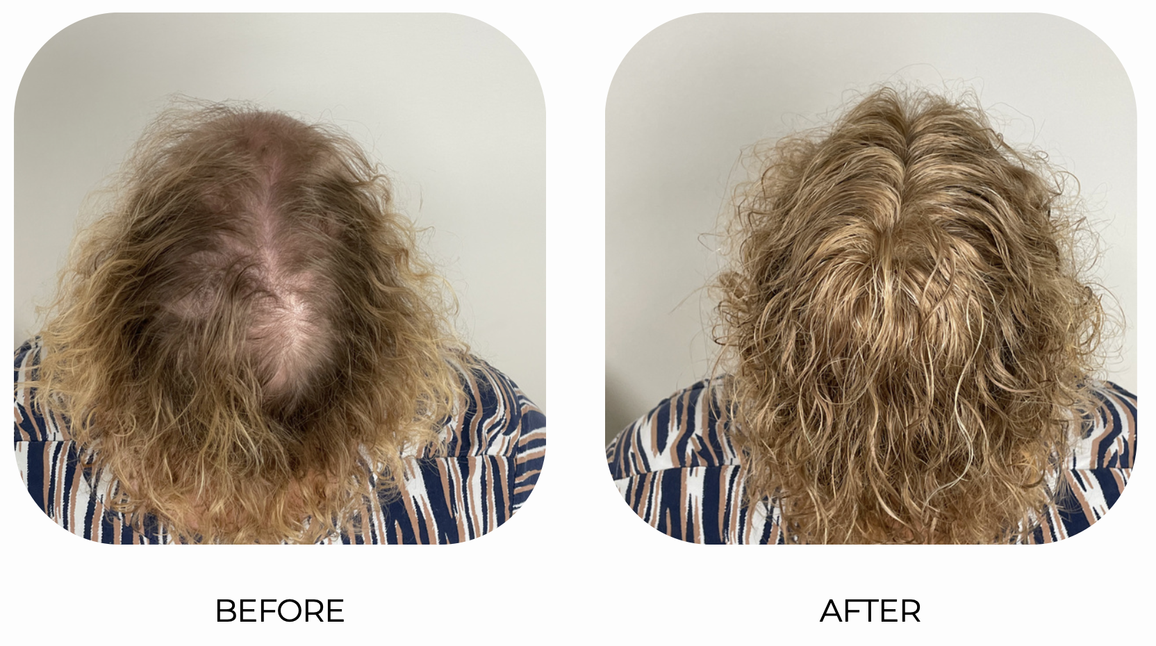 Comparison of a person's hair before and after hair treatment; before shows thinning, frizzy, and sparse hair on top, after shows fuller, wavier, and healthier hair with improved volume.