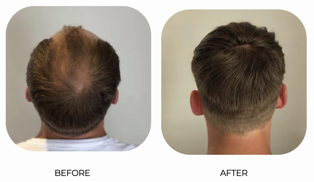 Side-by-side comparison of a man's hair before and after a haircut. The 'Before' shows thinning hair on the crown with visible scalp. The 'After' shows a fuller, neatly styled haircut with no visible scalp.