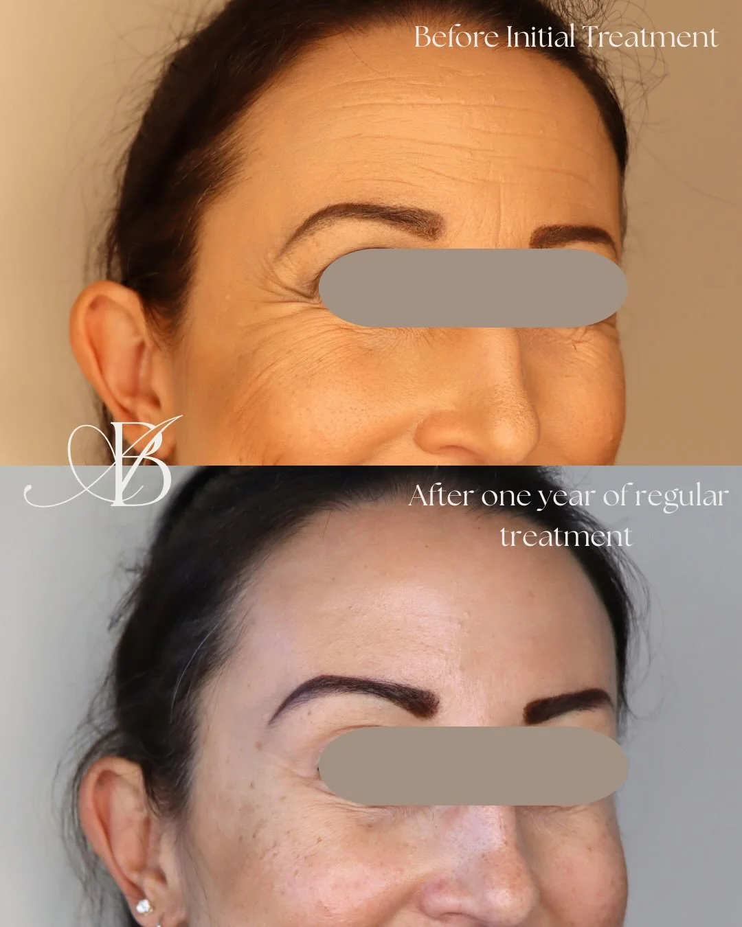 ✨ This isn&rsquo;t just another before-and-after wrinkle post&hellip;

It&rsquo;s a lesson in skin conditioning.
These results showcase what happens when Botox is used consistently over time&mdash;not just to soften movement, but to give the skin an 