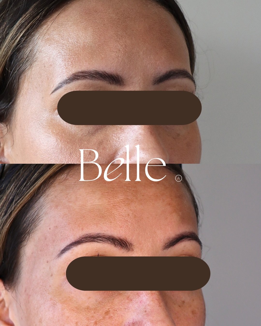 TEMPLE FILLER 🤍

One of the most underrated areas to treat&mdash;and one many people don&rsquo;t even realise can be enhanced. 🤍

Temple hollowing can occur as a natural part of ageing or simply because of genetics. When volume is lost in this area