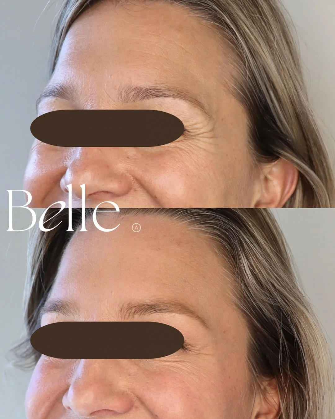 The Belle Effect 🤍

✔️ Soften
✔️ Lift
✔️ Glow
✔️ Freshen 
✔️ Make it look natural 

#botox #relfydess #antiwrinkle #glowup 

*Individual results may vary 

Botulinum toxin injections are prescription medicines for the treatment of frown lines, horiz
