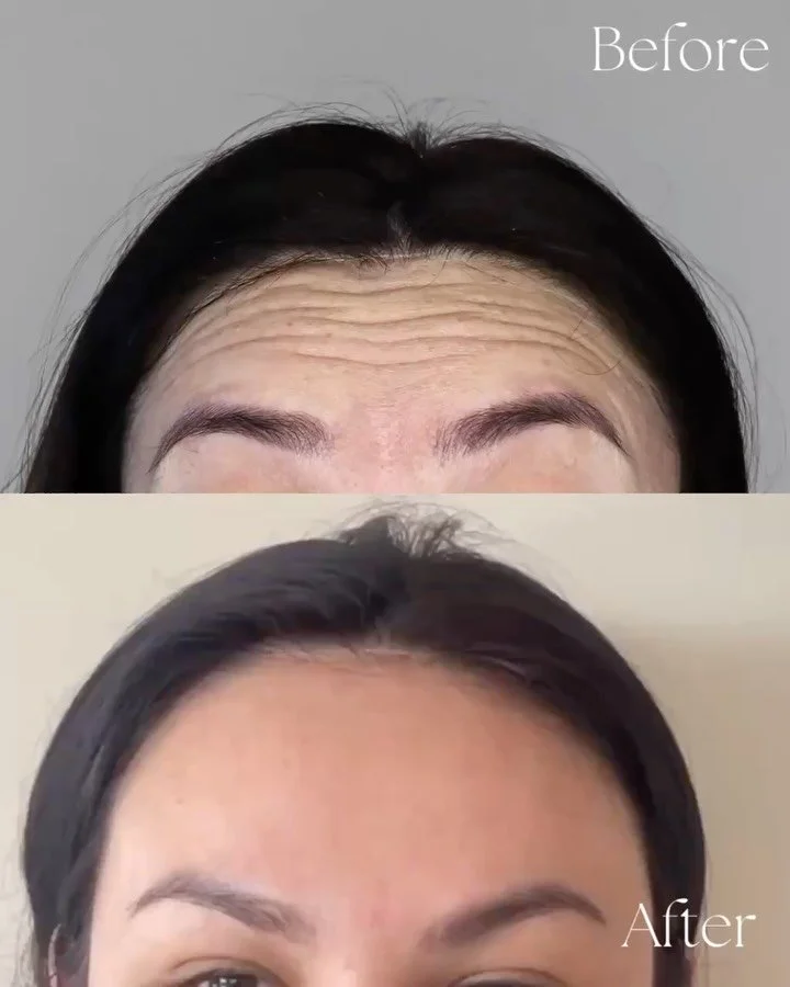 6 months of Relfydess 🤍

Six months ago, I introduced Relfydess into the clinic &mdash; and it&rsquo;s safe to say both myself and my clients have been loving it.

Think of it as a different &ldquo;flavour&rdquo; of toxin. While every person respond