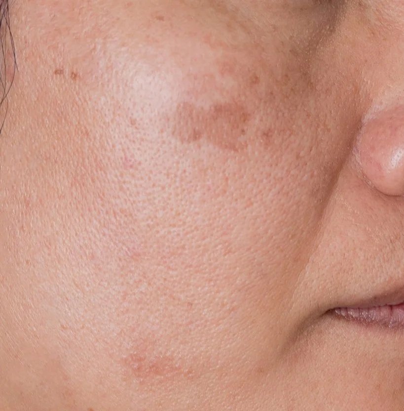 Close-up of a person's cheek showing uneven skin with hyperpigmentation, redness, and enlarged pores.