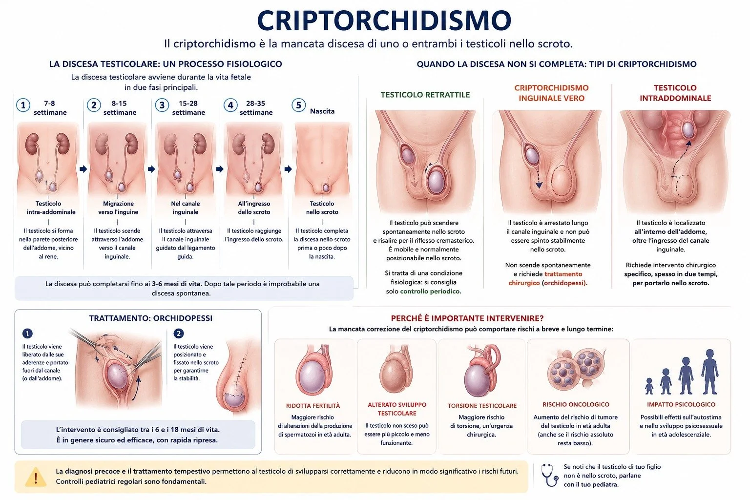 Il testicolo ritenuto

ll testicolo non disceso (criptorchidismo) &egrave; una condizione in cui uno o entrambi i testicoli non completano correttamente la loro discesa nello scroto durante la vita fetale (la discesa avviene infatti dall&rsquo;addome