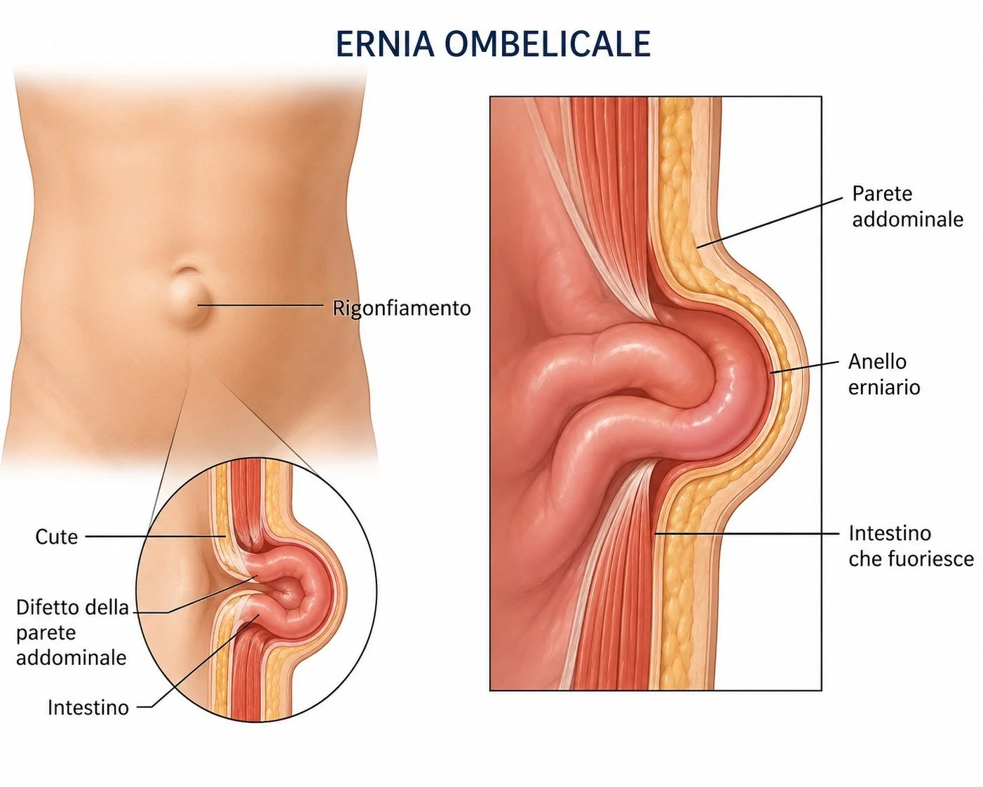 L'ernia ombelicale

L&rsquo;ernia ombelicale &egrave; una piccola apertura della parete addominale in corrispondenza dell&rsquo;ombelico, attraverso la quale pu&ograve; sporgere una parte dell&rsquo;intestino o del tessuto adiposo. &Egrave; frequente