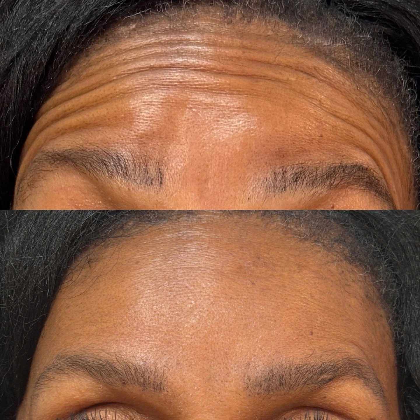 ✨ Smooth, refreshed, and naturally softened. ✨⁠
Just 14 units of Xeomin made a noticeable difference in these forehead lines while still keeping natural facial expression intact. 🤍⁠
⁠
Neurotoxins work by relaxing the muscles responsible for dynamic 