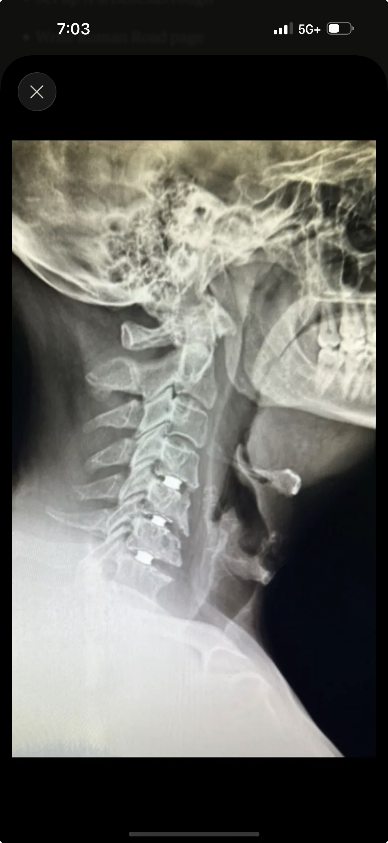 X-ray image of a person's neck and upper spine showing the cervical vertebrae.