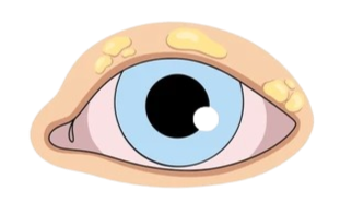 Close-up of a human eye with light blue iris and yellowish skin around it.