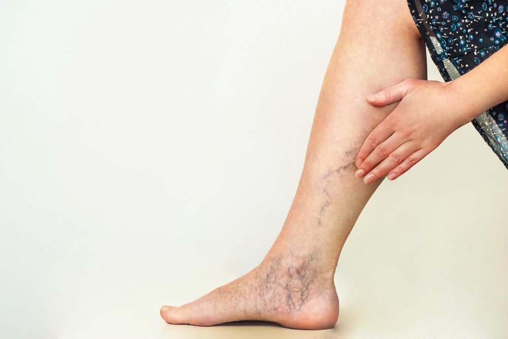 Person examining their leg with varicose veins and spider veins on the calf with a plain white background.