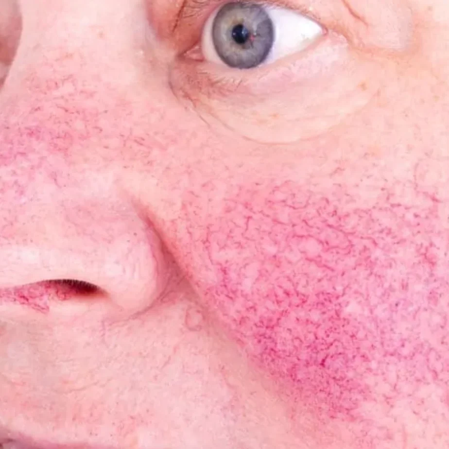 Close-up of a person's face showing redness and inflammation on the cheek and around the nose, with visible skin irritation.