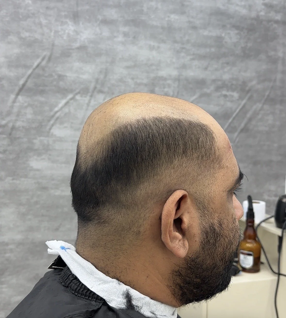 HAIR REPLACEMENT