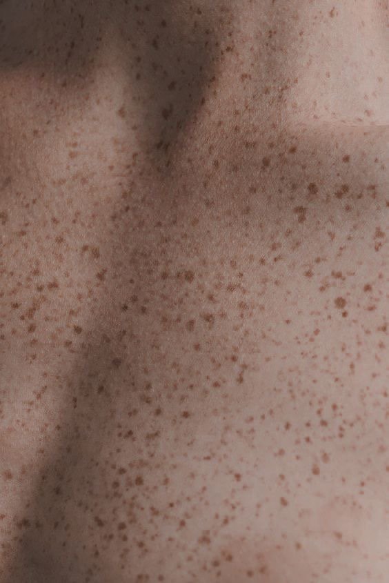 Close-up of human skin with freckles.