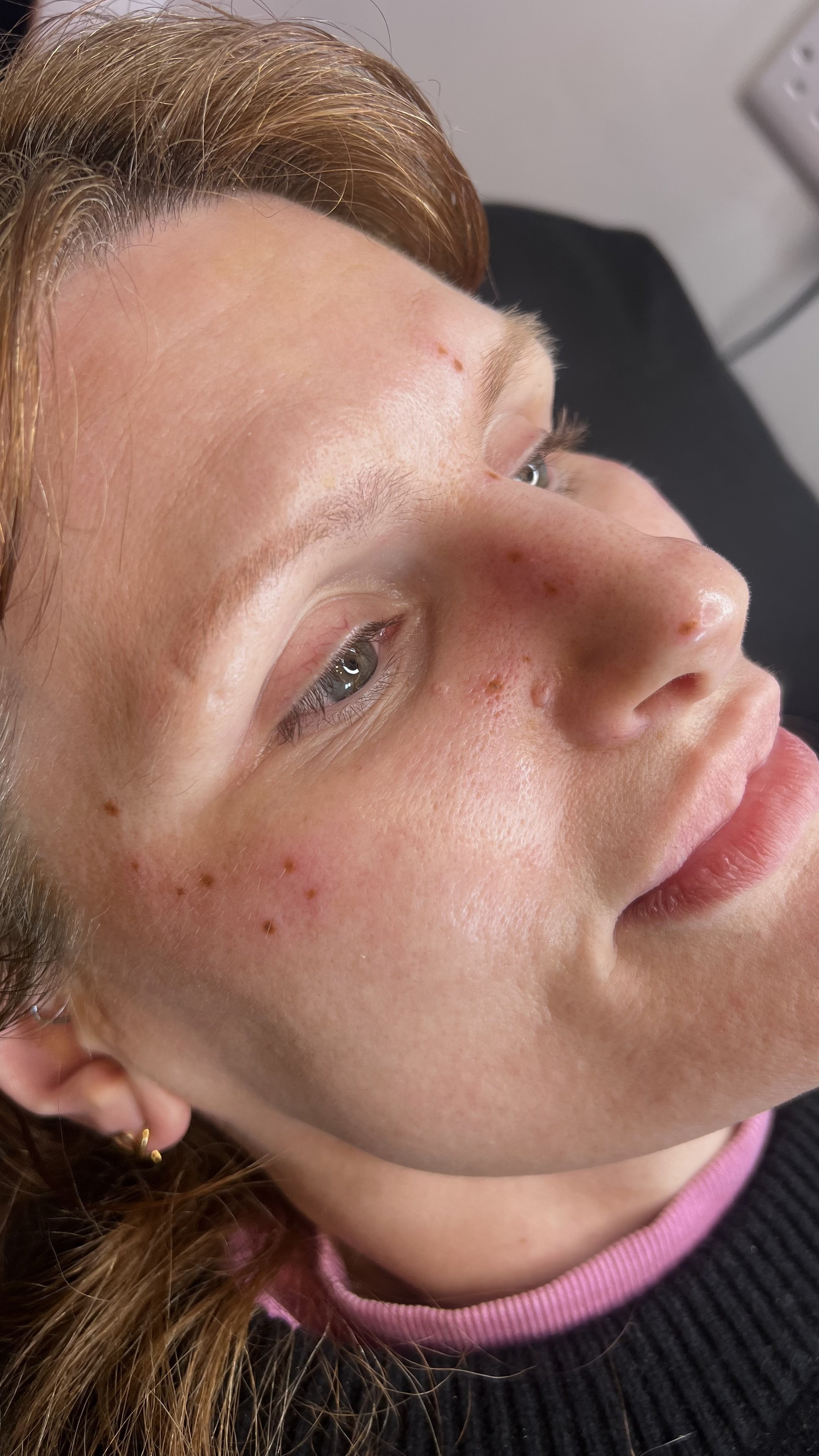 Close-up of a person's face, lying down, with light skin, reddish-brown hair, and visible freckles and pimples. Freckle tattoo, permanent make up, freckles, pmu artist, nottingham