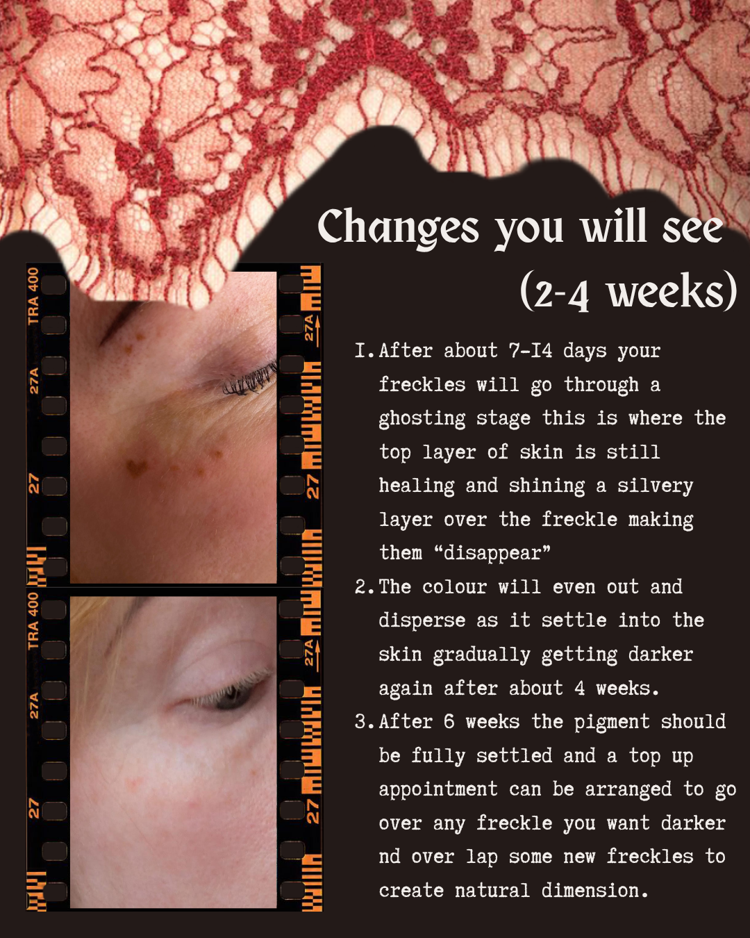Close-up image showing the before and after stages of a skin treatment for freckles, along with text explaining the healing process and timeline for color changes over 2-4 weeks.