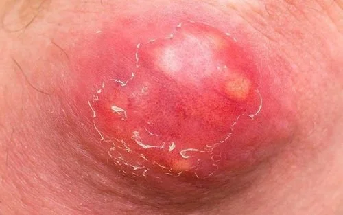 When Skin Hurts in Silence: Boils &amp; HS