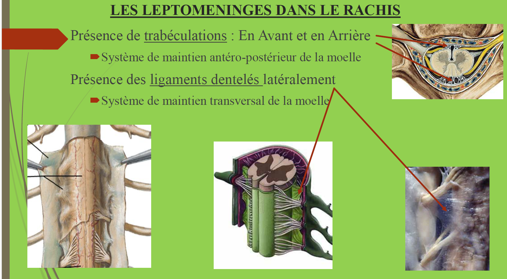 Schéma anatomique illustrant les lésions des léptomeninges dans le rachis, incluant la présence de trabéculations en avant et en arrière, les ligaments dentelés latéralement, et les systèmes de maintien antéro-postérieur et transversal de la moelle épinière.