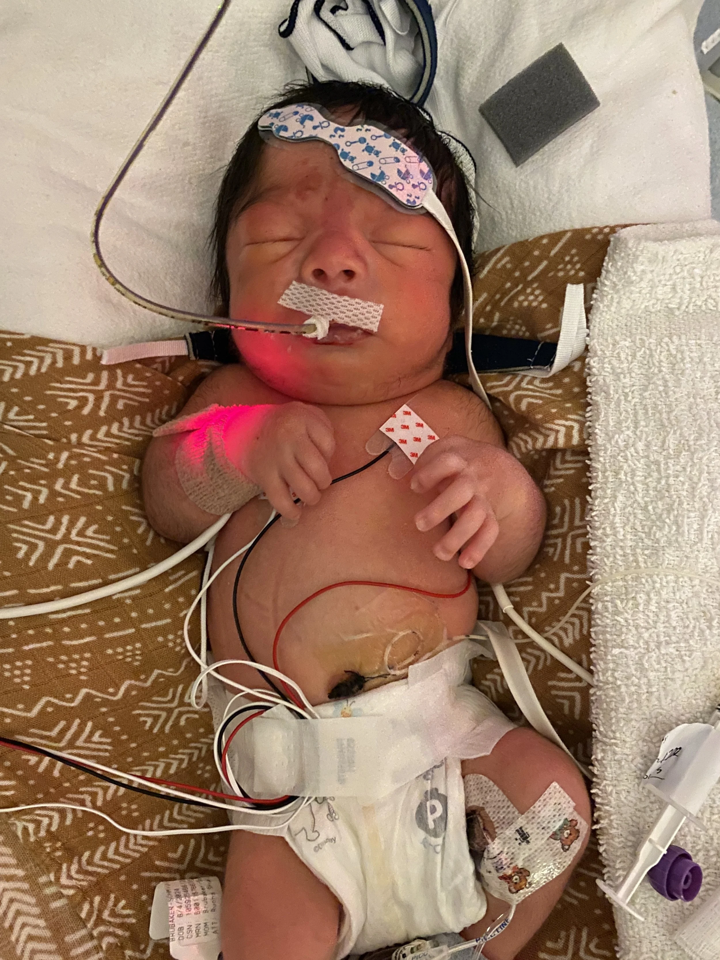 A newborn baby with closed eyes lying in a hospital bed, connected to medical devices with monitoring wires, wearing a diaper, with gauze and medical tape on its chest and head, and a white towel placed next to it.