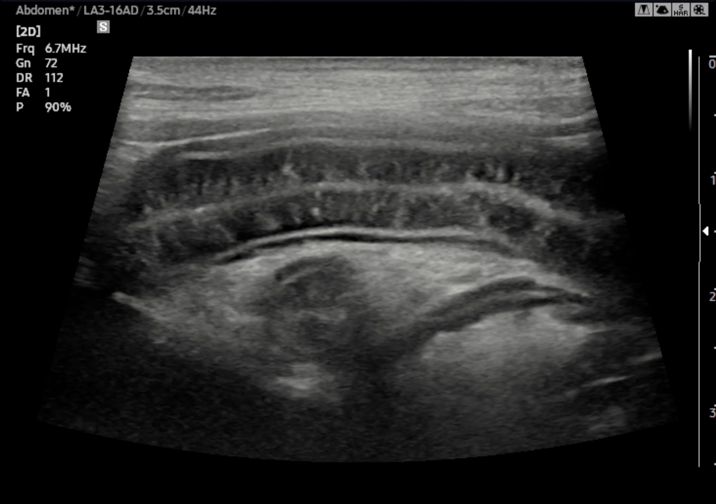 Ultrasound image of a dog's small intestine showing bright white streaks running through the intestinal wall, a sign of lymphangiectasia.