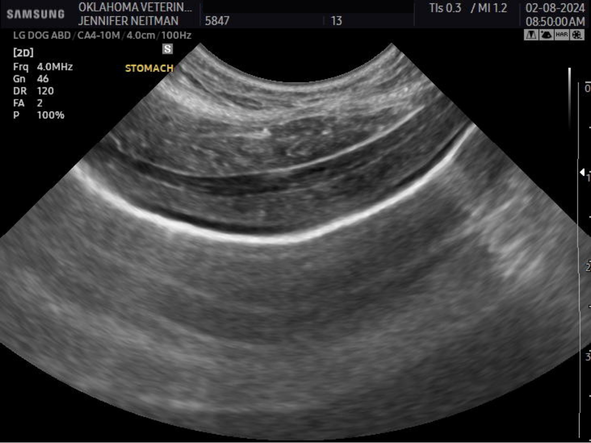 Pseudolayering gastric carcinoma