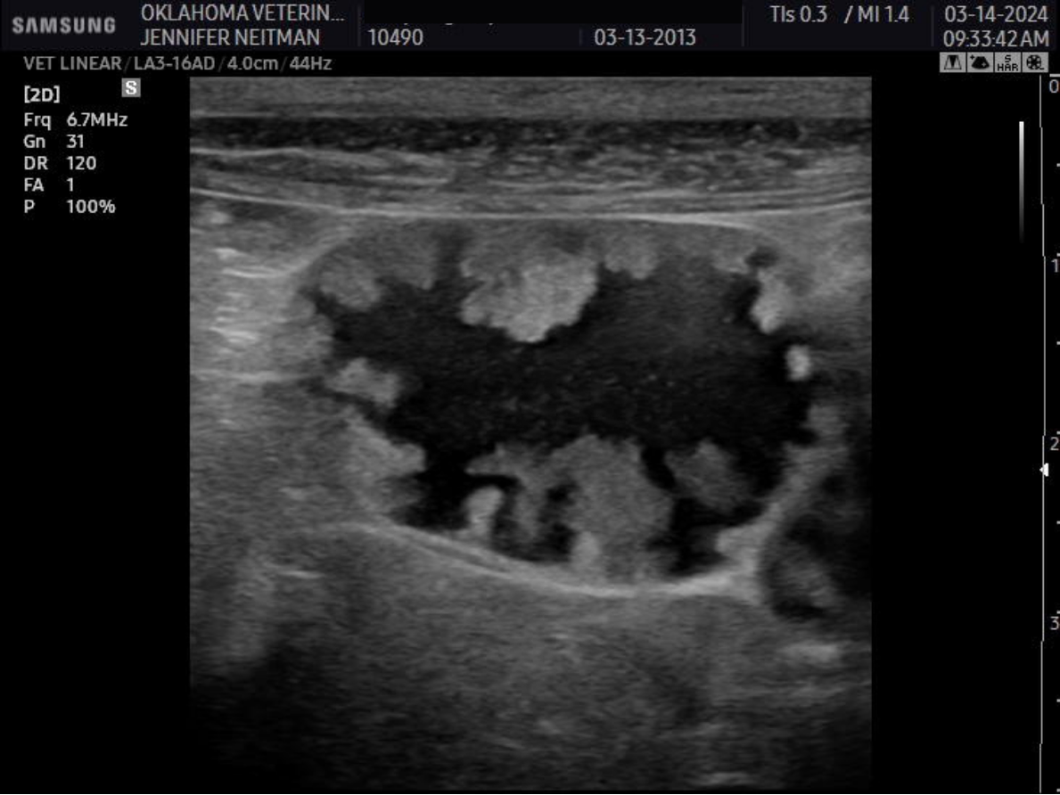 Chronic polypoid cholecystitis