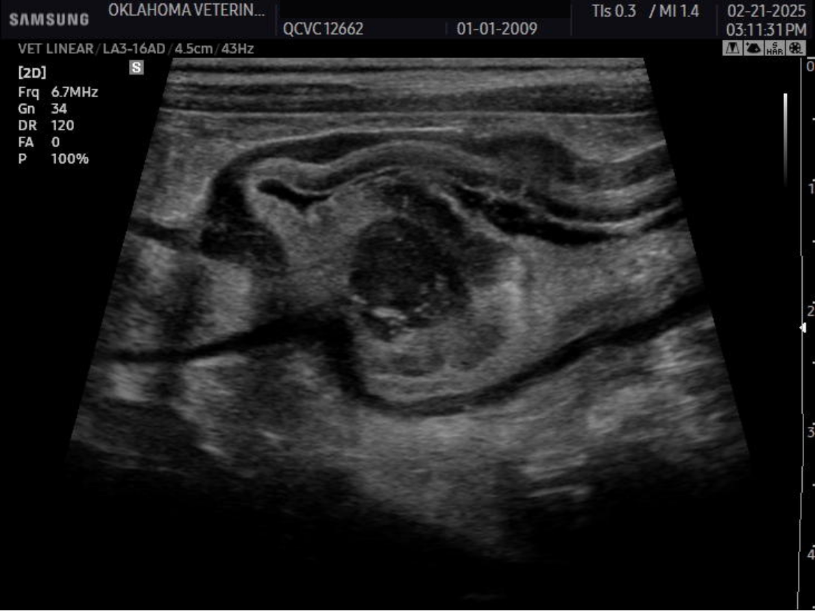 Obstructive Gastric Wall Polyp