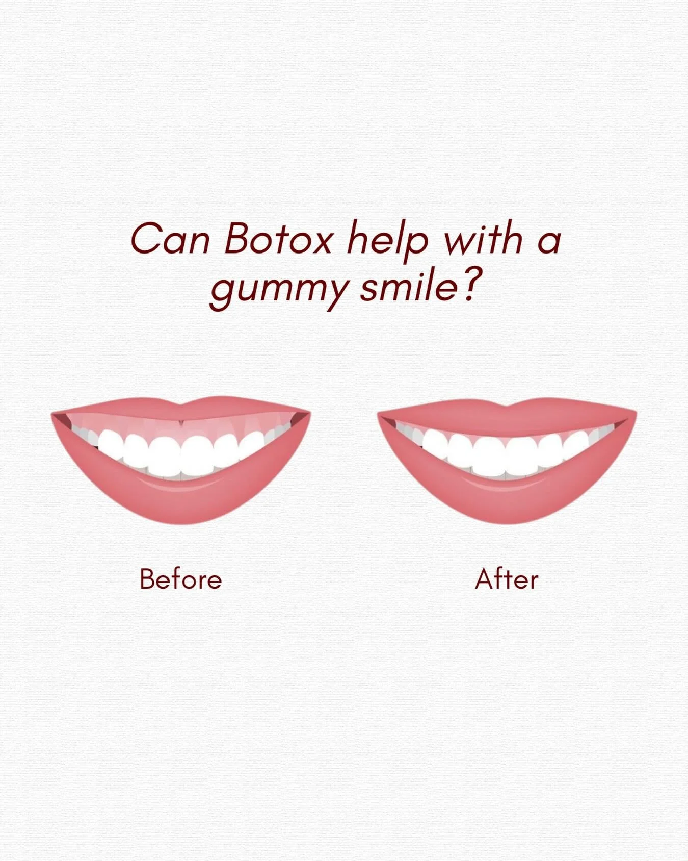 Yes! If your upper lip lifts too high when you smile, Botox can help relax the muscles responsible, creating a more balanced and natural-looking smile 👄

Treatment is quick, minimally invasive, and results can last several months!

Curious if you&rs