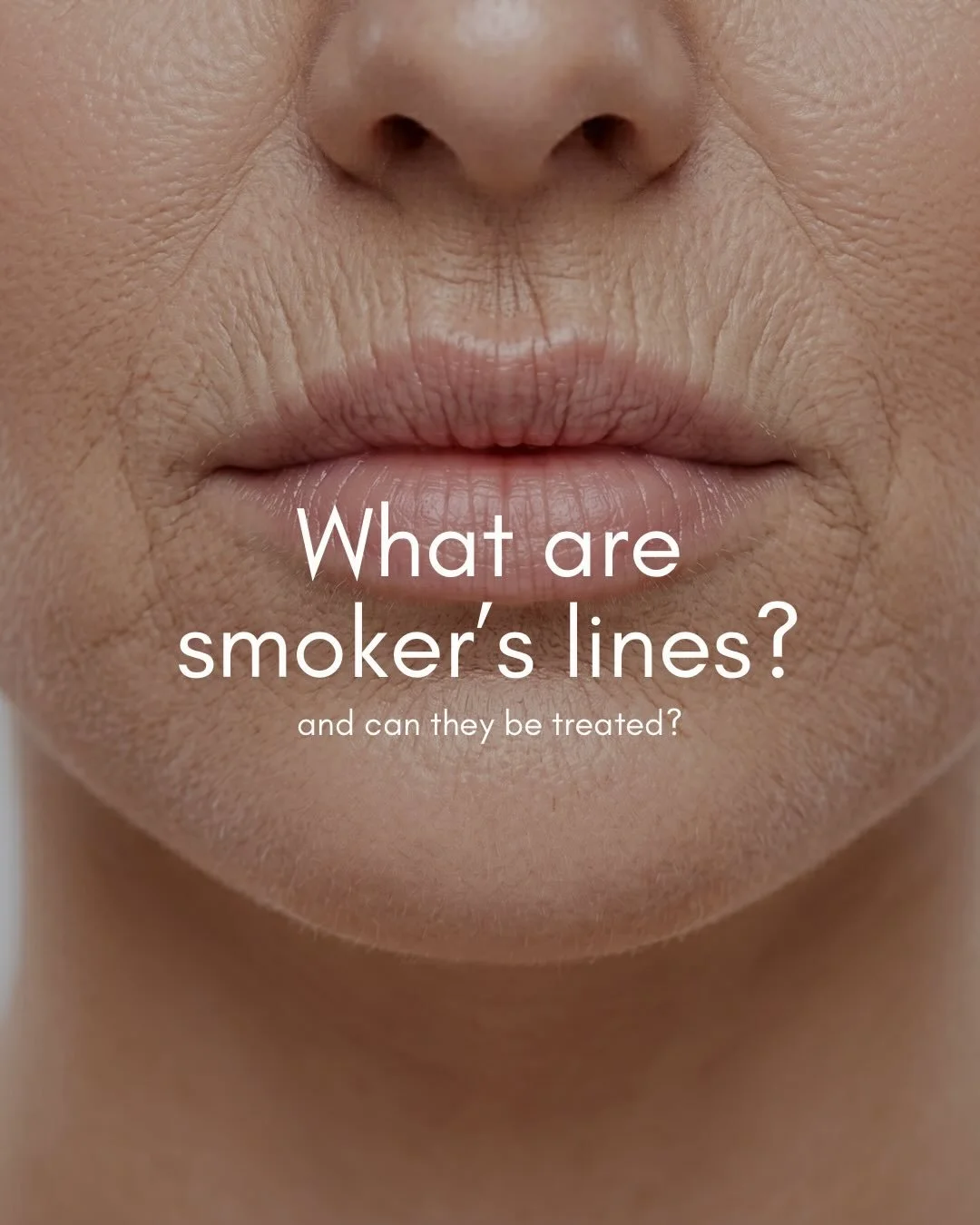 Smoker&rsquo;s lines aren&rsquo;t just caused by smoking. Aging, sun exposure, and the repetitive movements we make with our lips every day can all contribute to these fine vertical lines above the upper lip👄

Botox and Dysport help soften smoker&rs