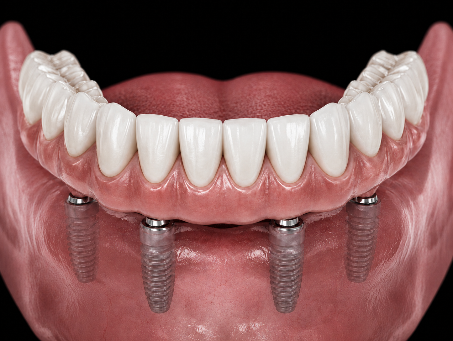 A digital illustration of an upper denture with artificial teeth and dental implants on a person's gums.