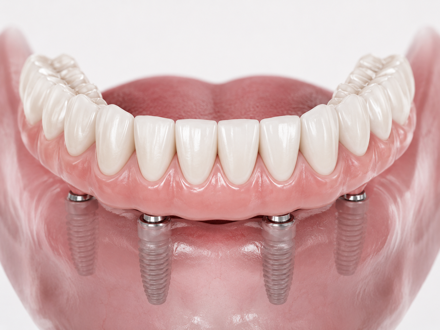 Full-Arch Implant