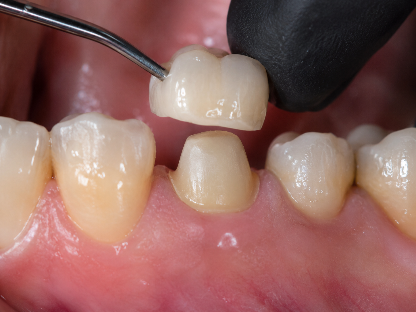 Close-up of dental procedure where a dental tool is applying a dental crown or veneer to a patient's upper front tooth.